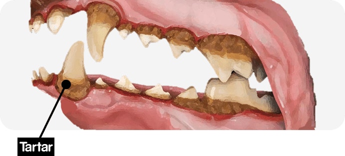 tartar teeth